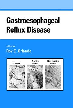 Gastroesophageal Reflux Disease