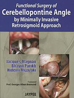 Functional Surgery of Cerebellopontine Angle by Minimally Invasive Retrosigmoid Approach