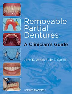 Removable Partial Dentures