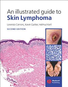 An Illustrated Guide to Skin Lymphoma