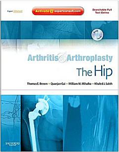 Arthritis and Arthroplasty: The Hip