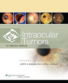 Intraocular Tumors