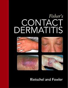 Fisher\'s Contact Dermatitis