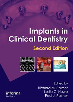 Implants in Clinical Dentistry