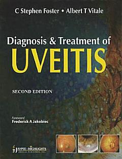 Diagnosis & Treatment of Uveitis